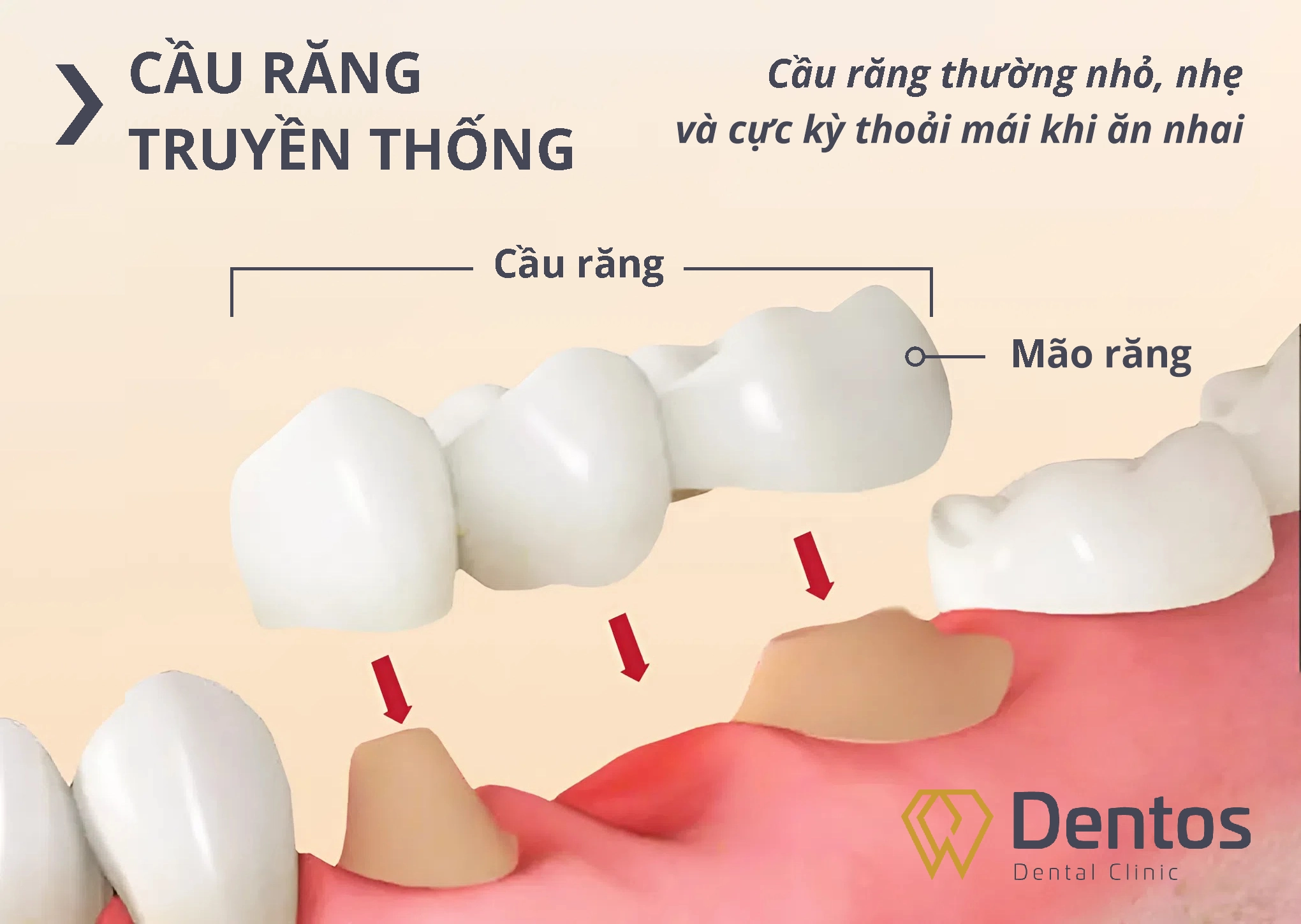 Làm cầu răng sứ yêu cầu mài hai răng thật khỏe mạnh bên cạnh để làm trụ đỡ cho dải sứ